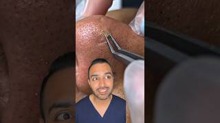 OMG I was not expecting that blackhead extraction on the nose Dr Somji reacts [upl. by Nide]