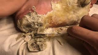 How to removal skin  callus removal skin flakes 53 [upl. by Arikal]