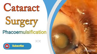 Cataract Surgery Complete With Phacoemulsification [upl. by Irpac112]