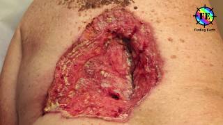 Skin Cancer  Symptom Causes amp Diagnosis Finding Earth [upl. by Arlena981]