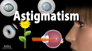 Astigmatism Types Causes Symptoms and Treatment Options Animation [upl. by Aikan]