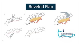 BEVELED FLAP PERIODONTAL FLAP SURGERY ON PALATAL ASPECT MODIFICATION OF APICALLY REPOSITIONED FLAP [upl. by Eitsim519]