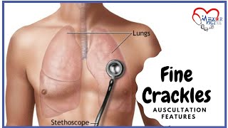 Fine Crackles  Lung Sounds  Auscultation Features [upl. by Stephannie879]