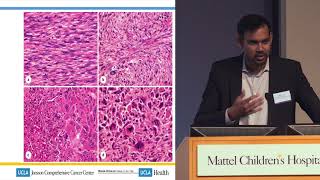 Sarcoma Developing Drugs for Rare Disease  Arun Singh MD  UCLA Cancer Care [upl. by Delaryd557]