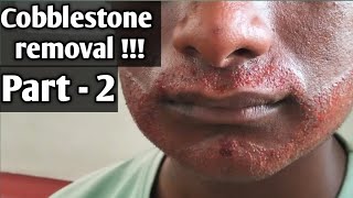 How to cure cobblestones cobblestone removal part 2  tamil [upl. by Nebur]