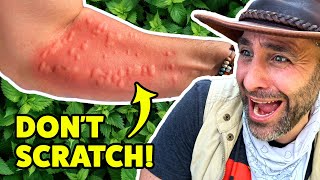 STUNG by a Costa Rican Bush [upl. by Eelibuj]