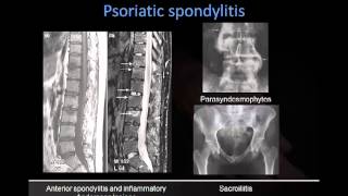 Dr Rick Chatwell Psoriatic Arthritis [upl. by Rehpinej]