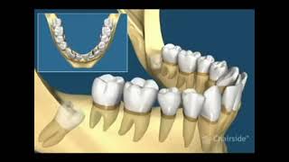 Dents de Sagesse  Tous les différents cas dextraction [upl. by Lymann]