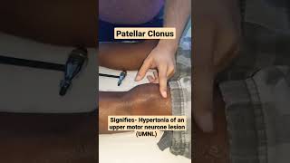 Patellar Clonus signifies hypertonia of an upper motor neurone lesion mbbs neet medicine usmle [upl. by Sergo]