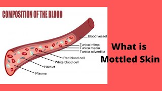Skin Mottling [upl. by Aiynot]