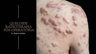 Tratamento de queloide radioterapia pósoperatória [upl. by Ahtenek]