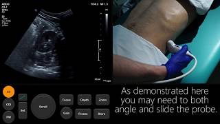 Ultrasound Tutorial Kidney amp Bladder  Urinary Tract  Radiology Nation [upl. by Llenahs]