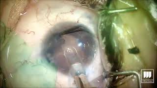 Iris prosthesis implant surgery [upl. by Schnabel426]