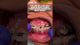 Reality of Dental Braces Treatment that All Patients Should Know  braces dentalbraces shorts [upl. by Brout588]