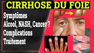 Cirrhose du Foie Clinique Complications Traitement  Gastrologie Medicale [upl. by Attenhoj]