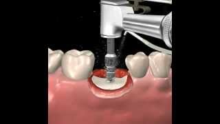 Step by step dental implant surgery Gary R OBrien DDS [upl. by Norabel]