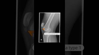 Symptomatic bipartite patella type 1 xray shoets [upl. by Eyma]