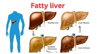 fatty liver Non Alcoholic FattyLiverDisease Liver Awareness Health Education [upl. by Acemat]