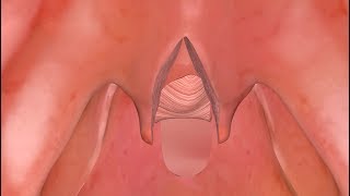 Posterior Pharyngeal Flap to Treat VPI [upl. by Brier761]