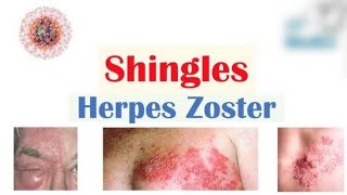 HERPES ZOSTERCAUSESSYMPTOMSMODE OF TRANSMISSIONTREATMENT [upl. by Junna862]