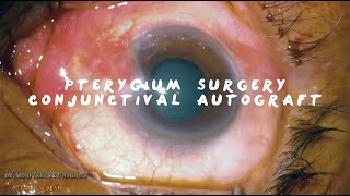 MIIQ 97 Pterygium Surgery Conjunctival Autograft with Sutures  DR MD IFTEKHER IQBAL RAJU [upl. by Kellby]