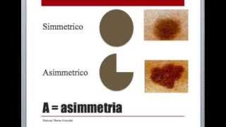 Autocontrollo dei nei  Prevenzione Melanoma [upl. by Kung]