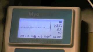 Myoguide and Ultrasound Guided Piriformis Syndrome Injection [upl. by Leaj773]