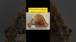 Miniscrew assisted palatal expansion dentist miniscrew manavgatdentist side [upl. by Etan]