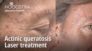 Actinic queratosis  Laser treatment  23276 [upl. by Seana749]