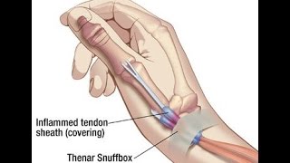 De Quervains Tenosynovitis [upl. by Novi]