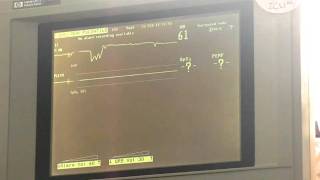 ECG WAVEFORMS [upl. by Dacy]