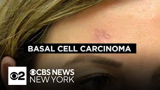 Dermatologist explains the dangers of basal cell carcinoma what to look out for [upl. by Stout]