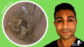 1414  Extreme Pruritus Dead Skin Keratin Removal  Read BSHAA Reply [upl. by Acirema454]