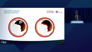 TCT 2022 Controversies in Calcium An OpenMinded Debate on Approaches to Nodular Calcium [upl. by Takeshi]