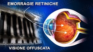 Occlusione vena centrale retinica terapia laser e chirurgica [upl. by Lounge]