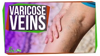 Why Do I Have Varicose Veins [upl. by Orest]