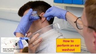 How to Perform an Ear Washout irrigation  ENTOtolaryngology Skills [upl. by Eizus123]