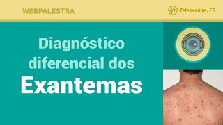 Webpalestra Diagnóstico diferencial dos Exantemas  Telessaúde ES 02062016 [upl. by Hathaway789]