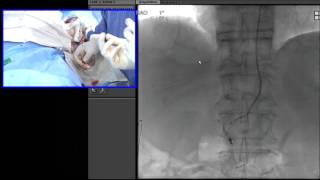 Transradial Embolization of the Right Gastric Artery Prior to Y90 Radioembolization [upl. by Slinkman520]