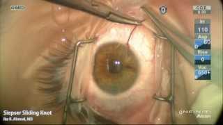 Modified Seipser Sliding Knot for Iris Suturing Ike Ahmed [upl. by Mecke]