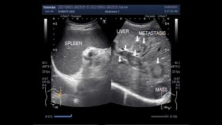 Multiple Hepatic metastases [upl. by Eppillihp]