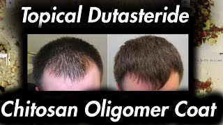 Topical Dutasteride Chitosan Coat for BETTER Results [upl. by Wahkuna]