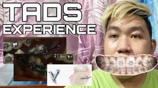 TADS EXPERIENCE  AFTER A WEEKS Know more about TADs [upl. by Annia]