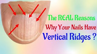 The REAL Reasons Why Your Nails Have Vertical How to Treat and Fix Vertical Ridges [upl. by Lorenzo]