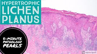 Hypertrophic Lichen Planus 5Minute Pathology Pearls [upl. by Sedecram]