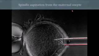 Reconstruction of oocytes by meiotic spindle transferring [upl. by Ming]