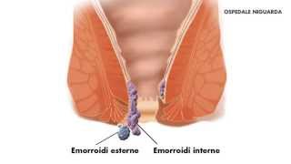 Emorroidectomia [upl. by Aydan]