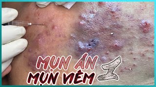 Big Cystic Acne Blackheads Extraction Blackheads amp Milia Whiteheads Removal Pimple Popping [upl. by Eidua]