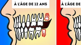 Aton Vraiment Besoin de Retirer Nos Dents de Sagesse [upl. by Annoved192]