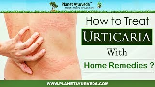 How to Treat Urticaria with Home Remedies [upl. by Elyod]